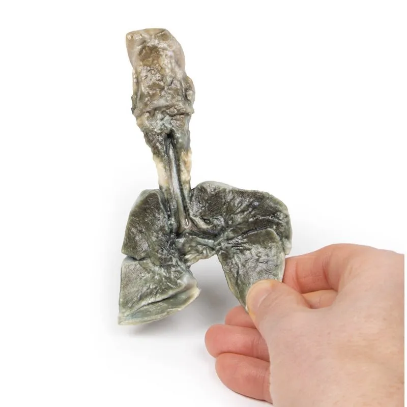 3D Printed Tracheoesophageal Fistula and Oesophagus Atresia